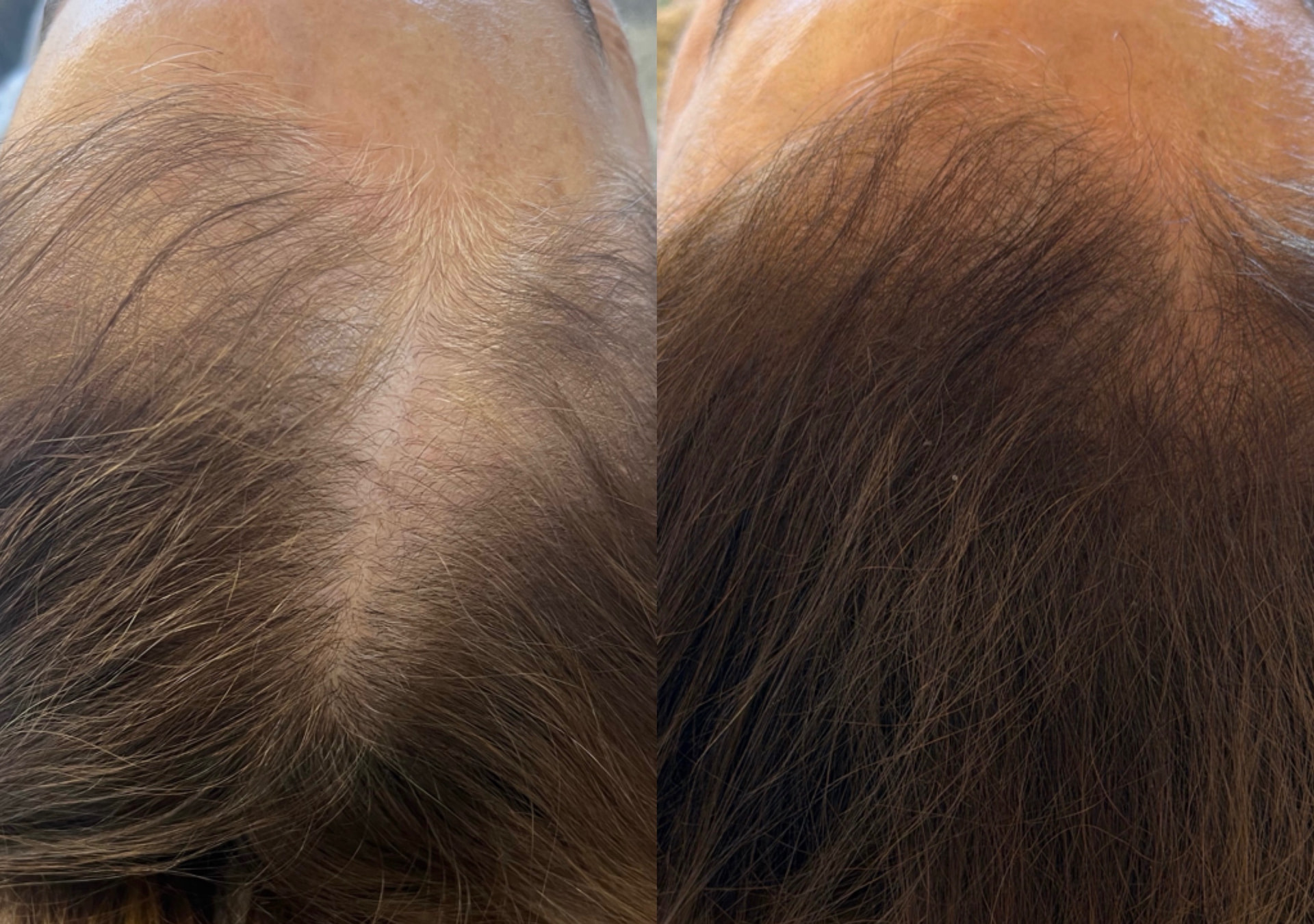 Before and after hair restoration results showing improved density along the part and hairline
