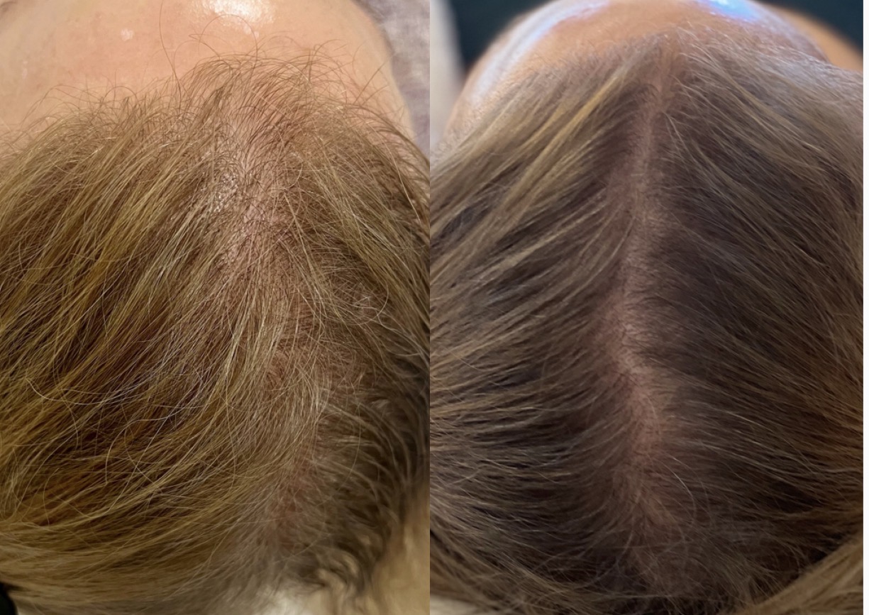 Before and after hair restoration comparison showing fuller, denser hair