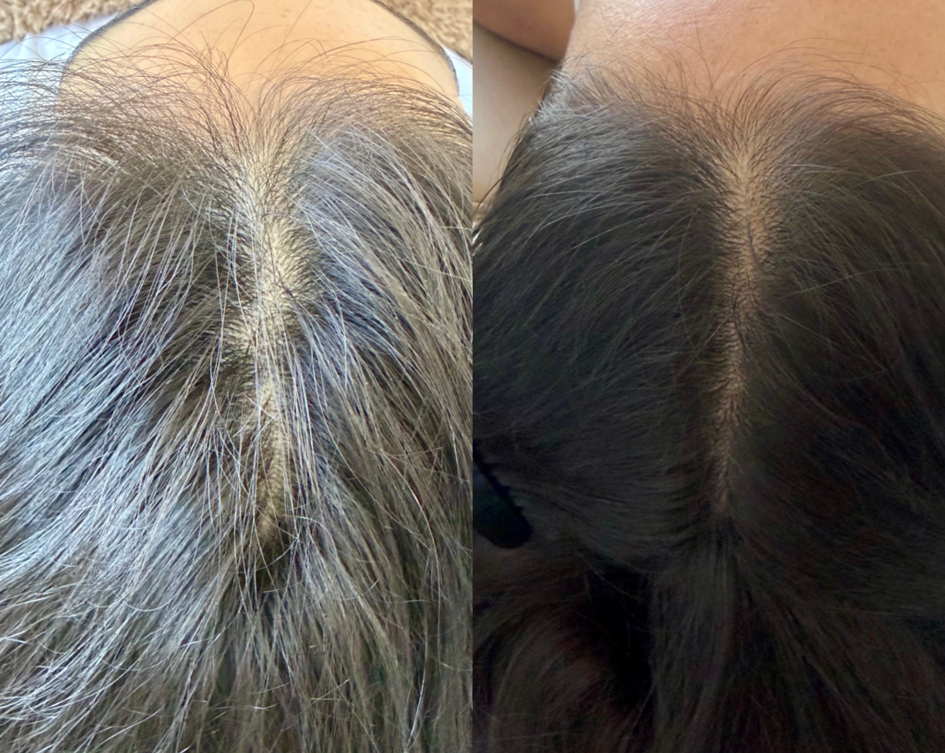 Before and after hair restoration results showing fuller coverage through the crown and part