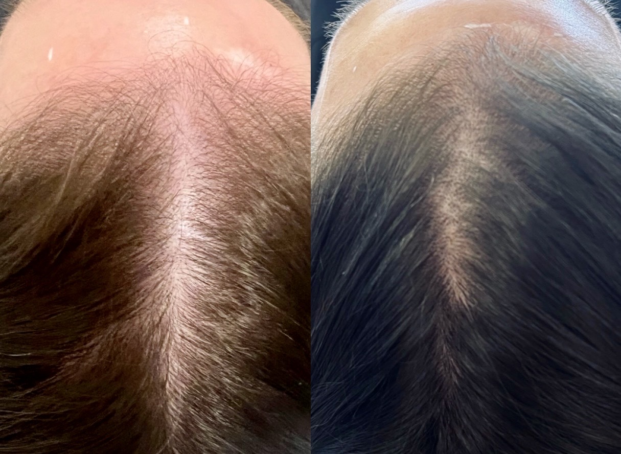 Before and after hair restoration comparison showing improved hair density