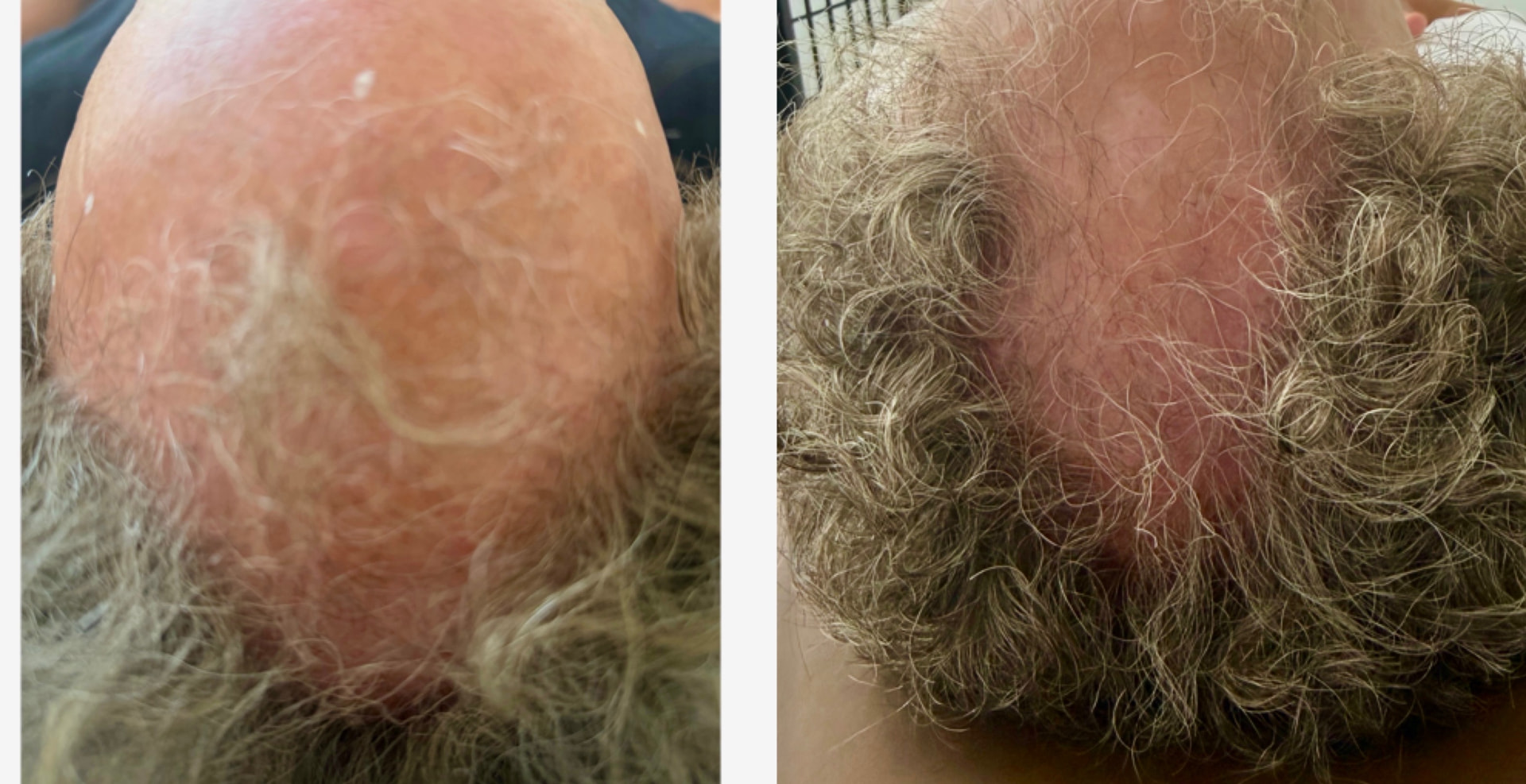 Before and after hair restoration comparison showing increased hair coverage across the crown